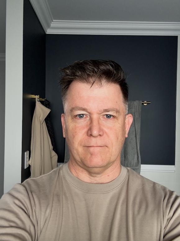 Efudix day 1 — face at the start of treatment, no visible reaction yet
