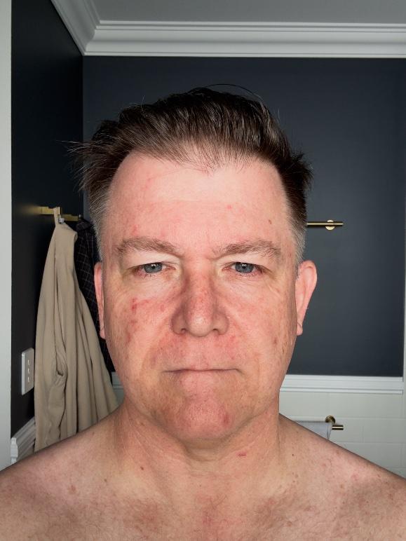 Efudix day 7 — pink patches darkening, skin feeling tight and dry