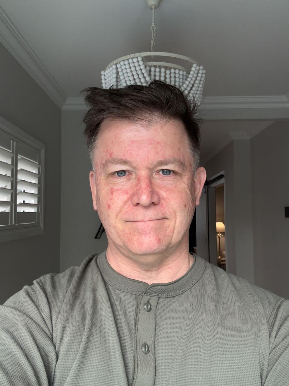 Efudix day 10 — red inflamed skin that feels hot like sunburn