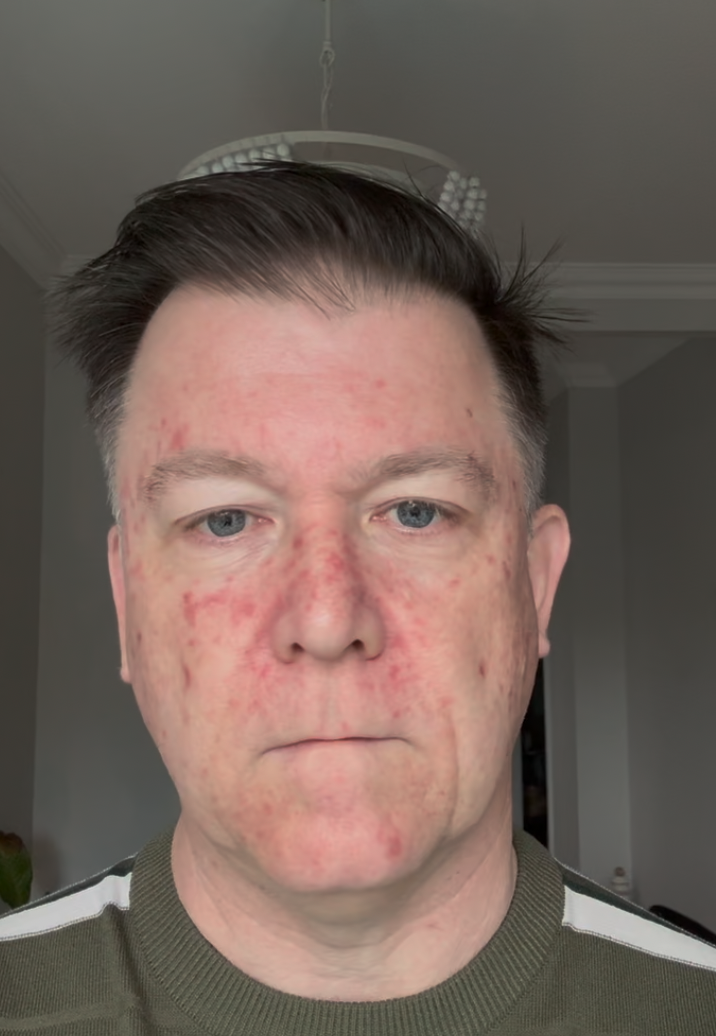Efudix day 12 — flaking starting around the nose and forehead