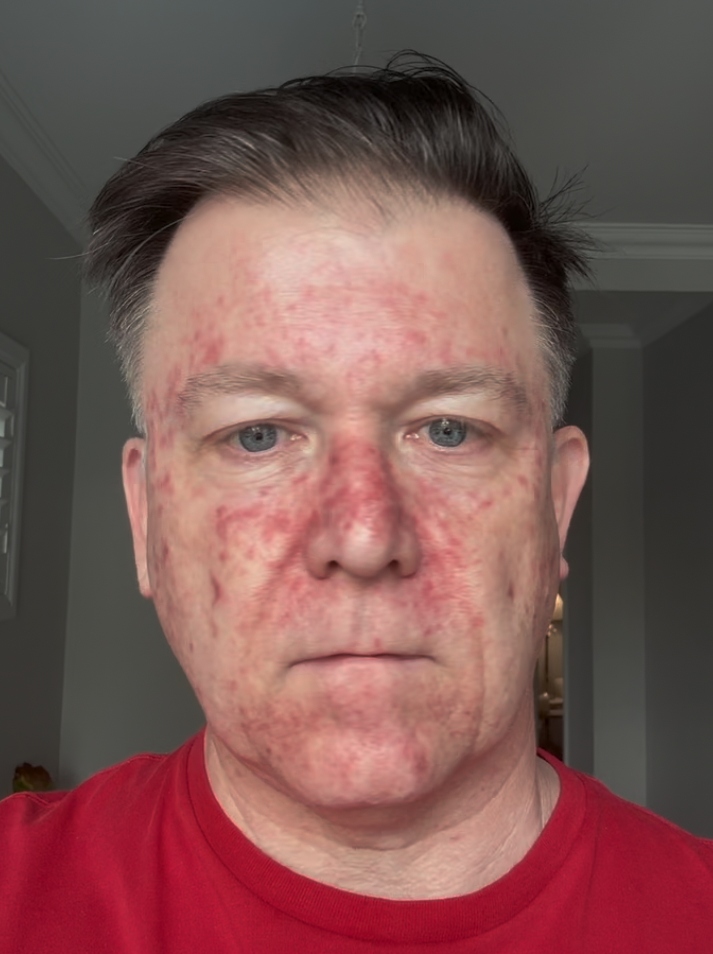Efudix day 14 — widespread sunburn-like redness at the end of week two