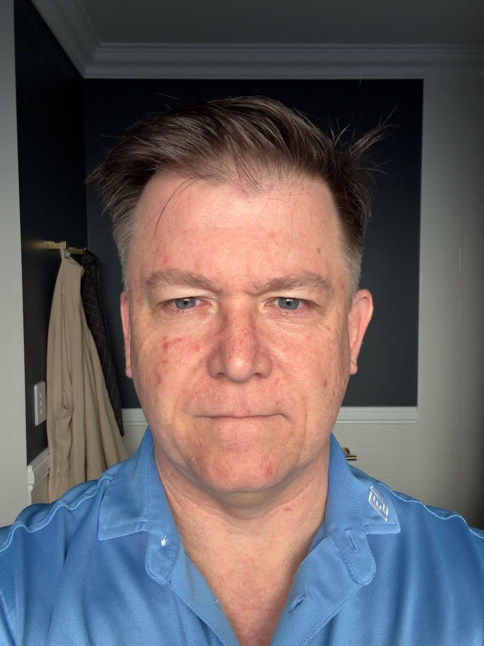 Efudix day 8 — bright red angry-looking spots developing on the face