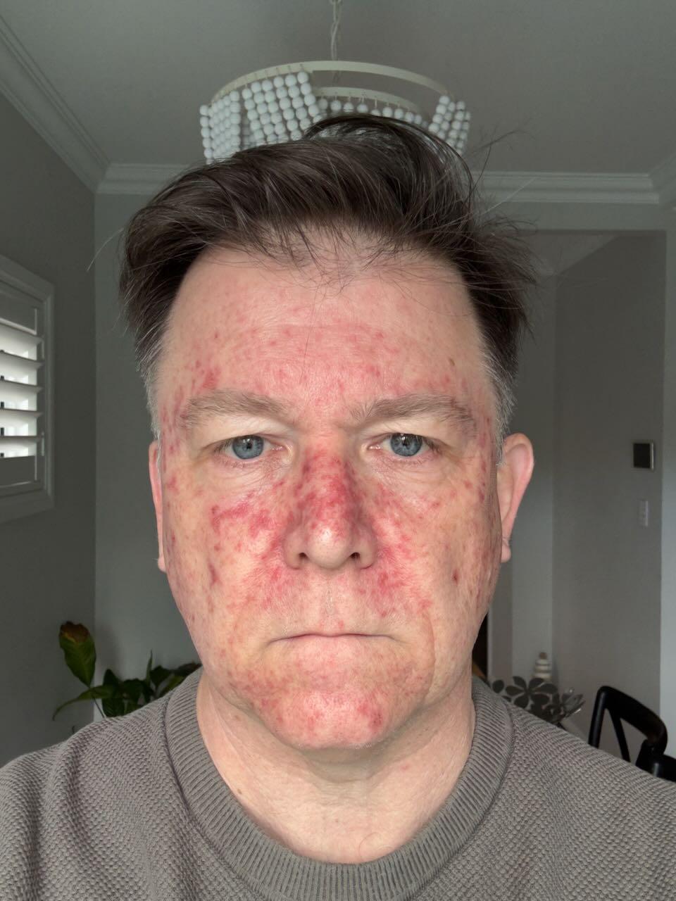 Efudix day 15 — peak reaction, raw crusty red skin across the treated areas