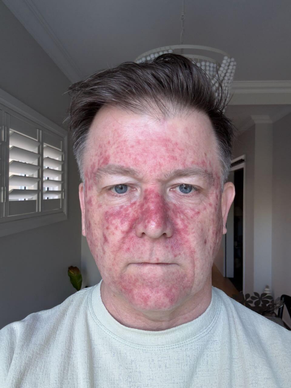 Efudix day 17 — crusty red skin with constant burning sensation
