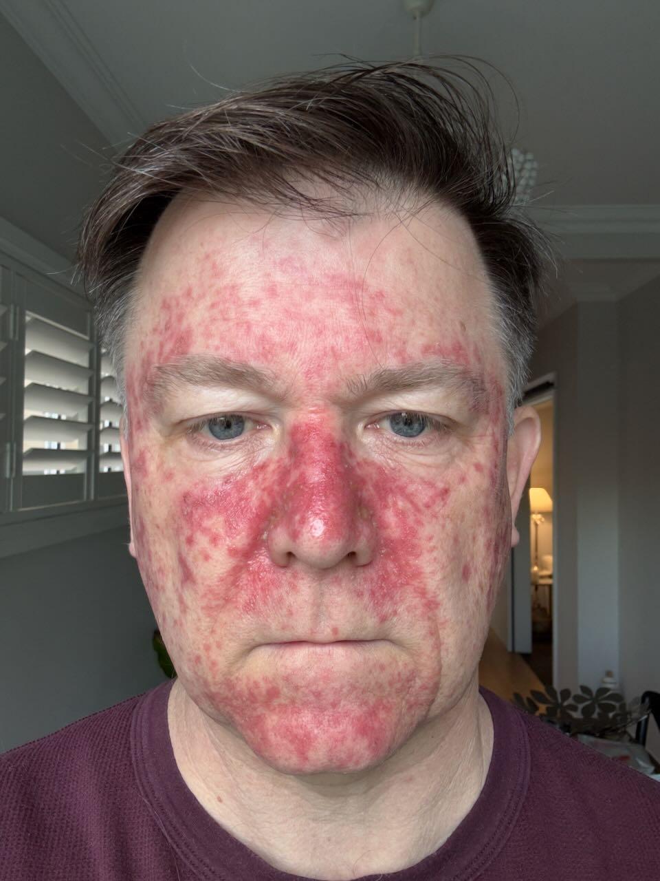 Efudix day 19 — the worst of the reaction, skin raw and inflamed