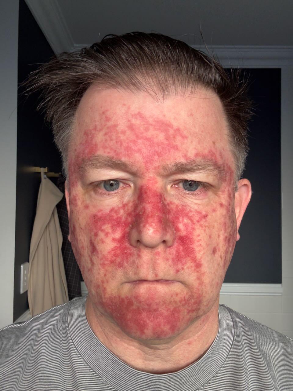 Efudix day 21 — last days of application, treated skin fully reacted