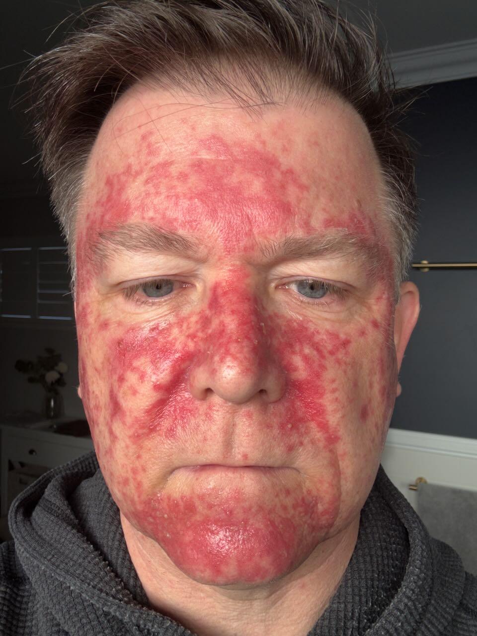 One day after stopping Efudix — burning easing, peeling about to start