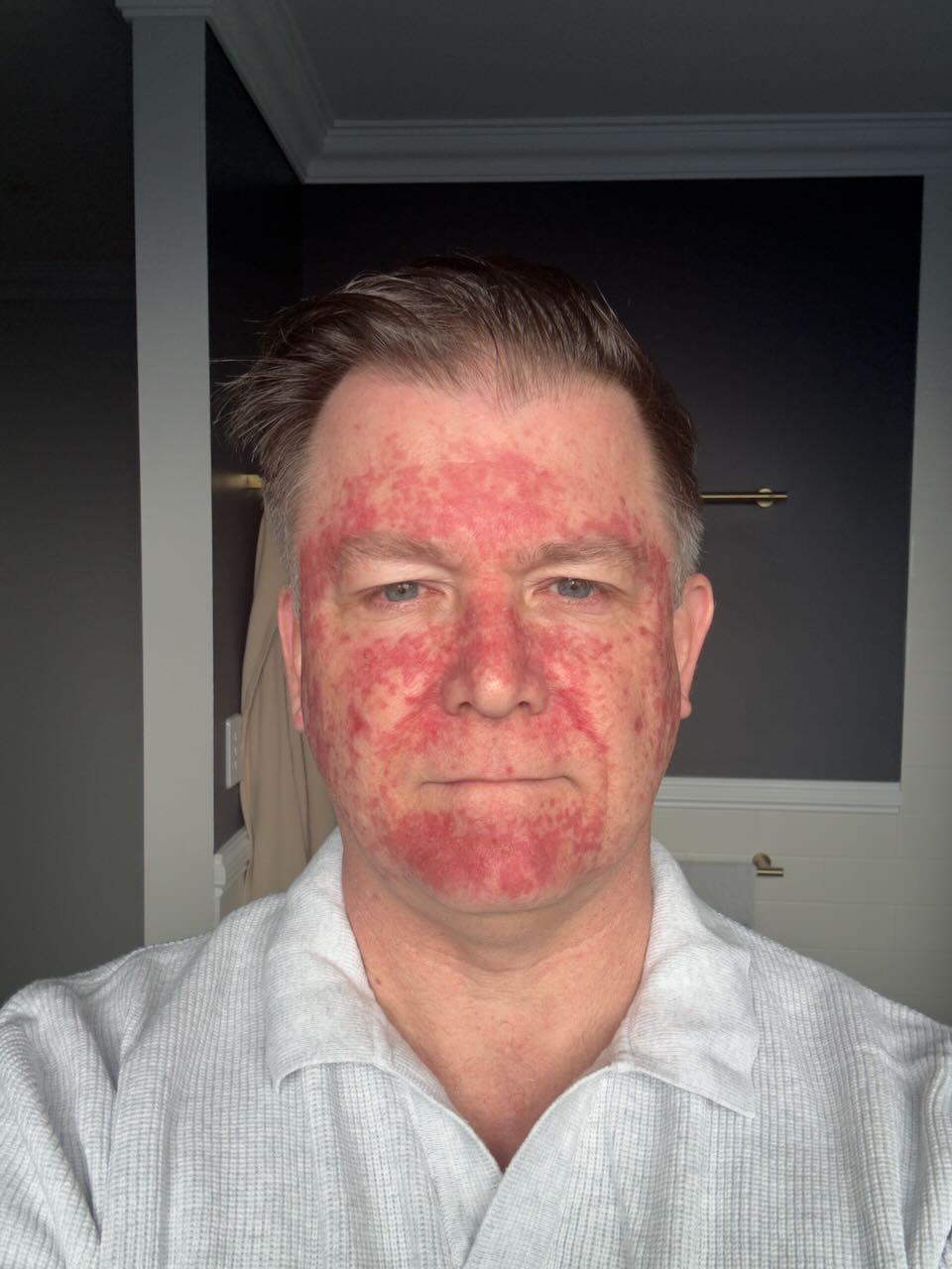 Three days after stopping Efudix — big flakes of dry skin coming away