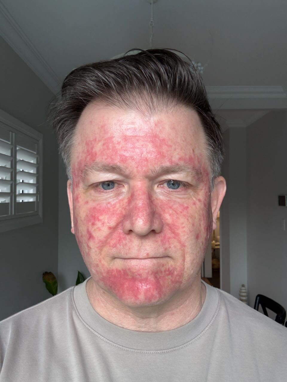 Five days after stopping Efudix — bright pink new skin showing under the peeling