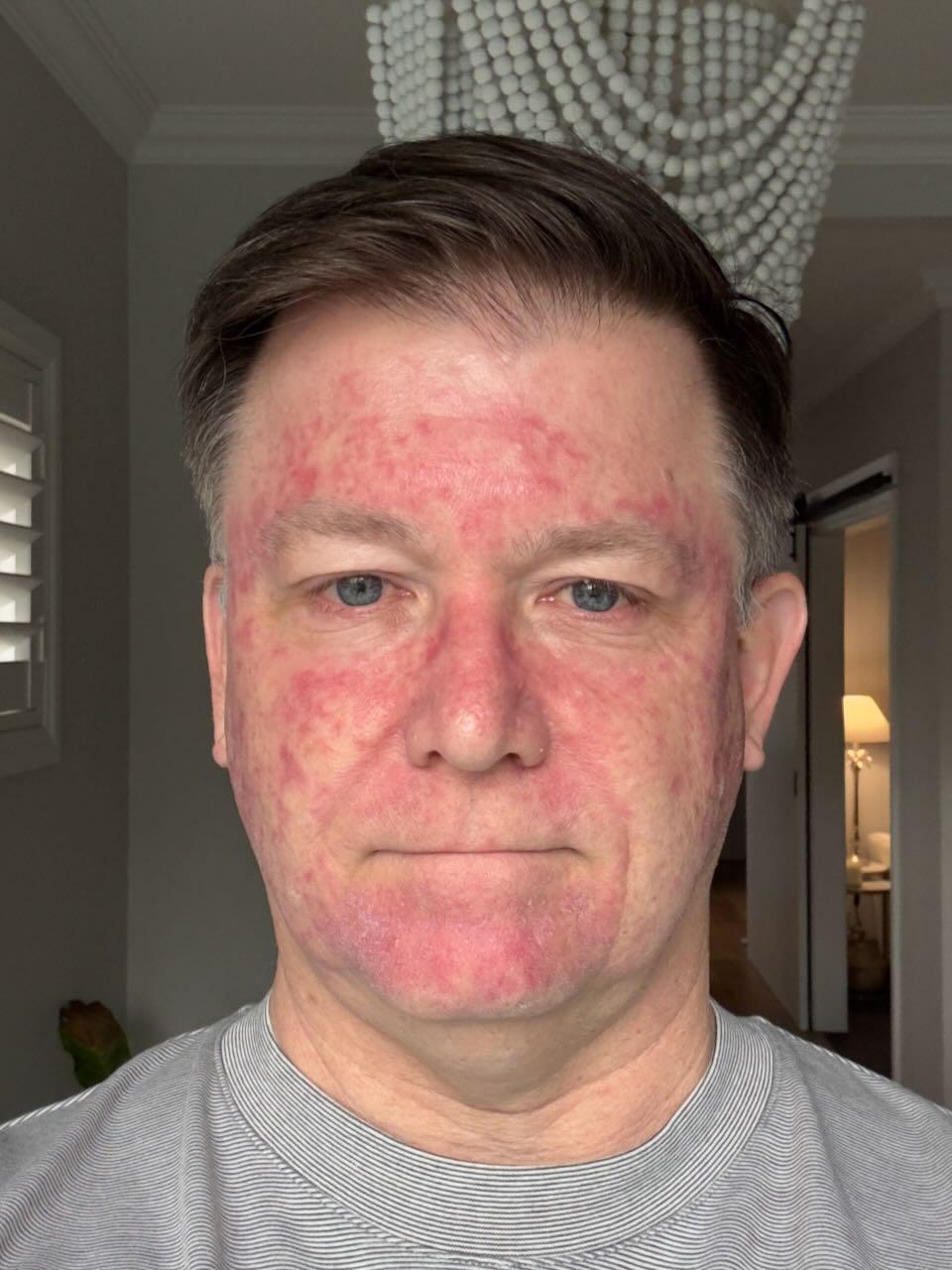 One week after stopping Efudix — healing well, most crusting gone
