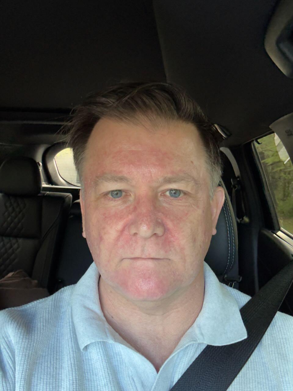 Ten days after stopping Efudix — lighter pink skin, raw feeling gone