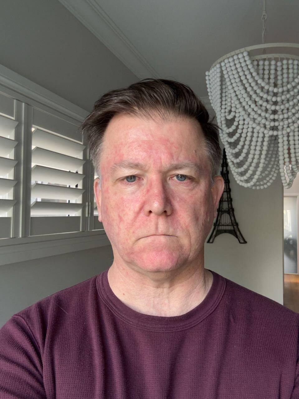 Twelve days after stopping Efudix — peeling nearly finished, smooth new skin