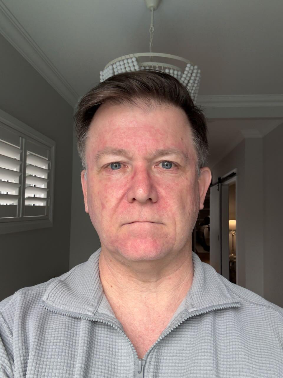 Two weeks after stopping Efudix — healed skin, face returning to normal