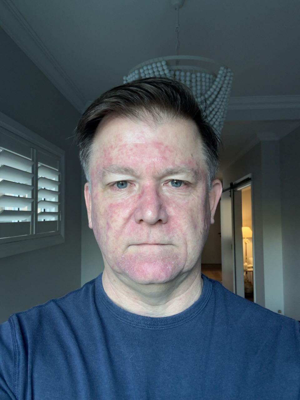 Eight days after stopping Efudix — deep redness starting to fade